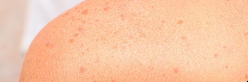 Bronzlaşırken Leke Oluşumu Nasıl Önlenir Melanin Yönetimi